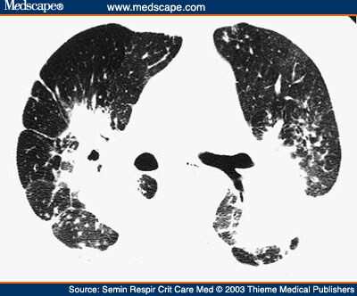 Alveolar Sarcoid