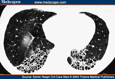 honeycomb appearance lung