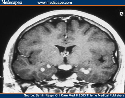 multiple sclerosis mri scan. MRI scan. Multiple