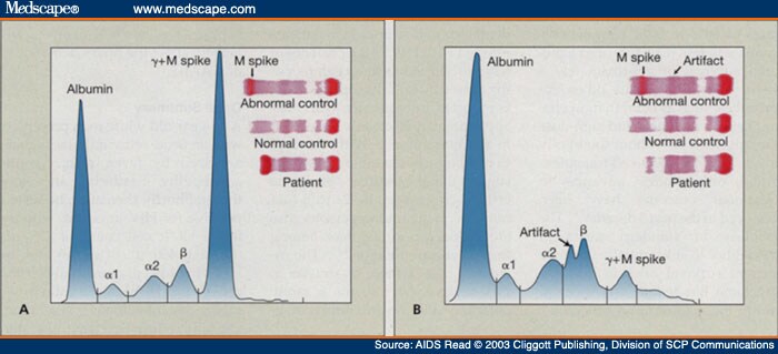 Initial serum protein electrophoresis showing an M spike of more than 5 g/dL 