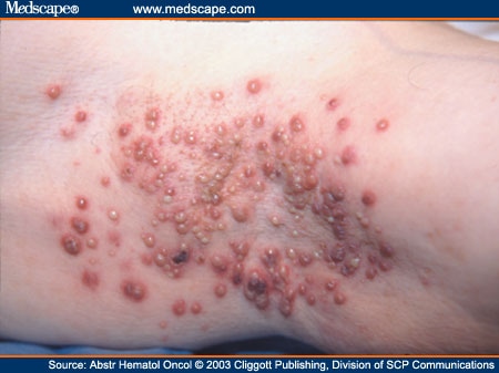 Pseudomonas aeruginosa skin and soft tissue infections