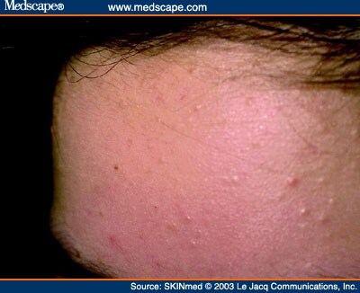 Inflammatory lesions of papulopustular rosacea: ivermectin ...