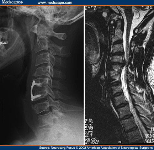 Herniated Disc In Neck. Note the large disc herniation