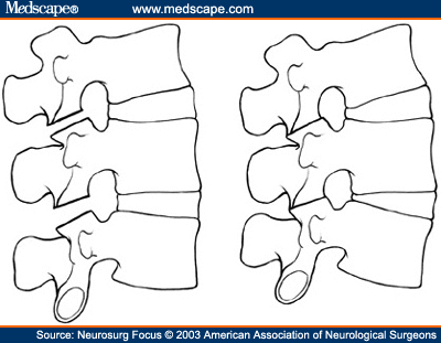 Spinal Osteotomies