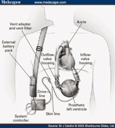 Lvad Driveline