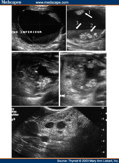 Thyroid Cysts Symptoms