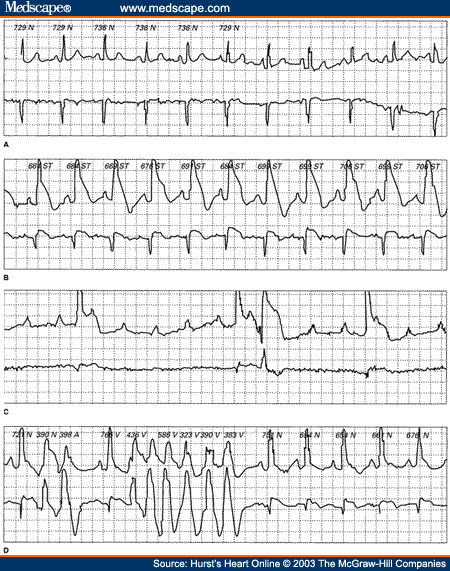 Long-term Continuous Electrocardiographic Recording