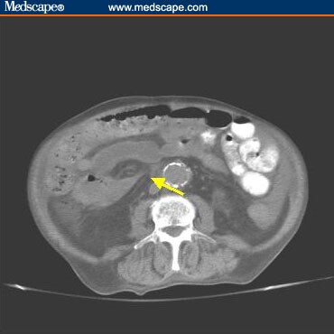 Mid Abdomen