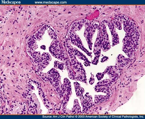 bleeding-after-laser-prostate-surgery-prostatic-adenocarcinoma-mri