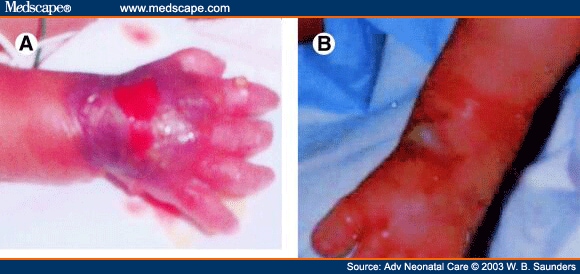 (A) Infiltration of this peripheral IV in the hand was noticed after the 