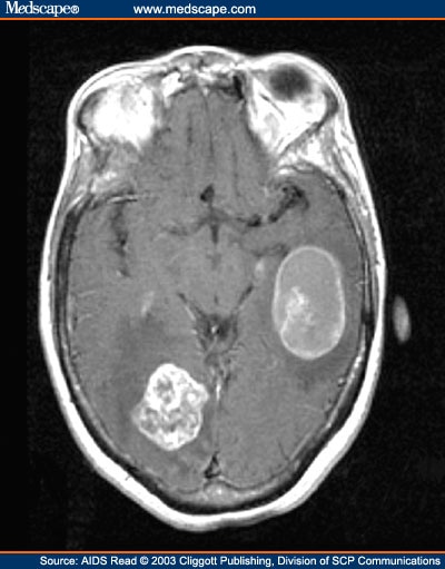 mri brain scan. MRI scan of the rain.