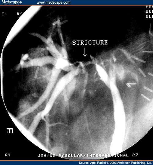 Percutaneous Transhepatic Cholangiography. (B) Percutaneous transhepatic