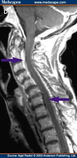 Cerebral Hypotension