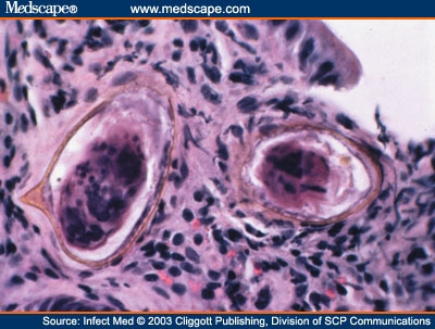 A Brazilian Immigrant With Spinal Schistosomiasis