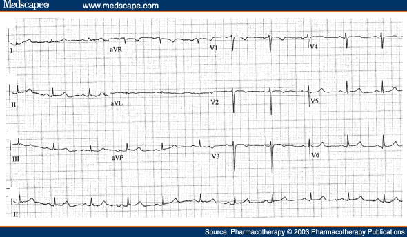 ecg-interpretation-ecg-interpretation-review-84-st-depression-st