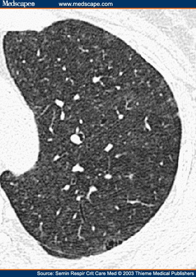 bronchiolitis in adults