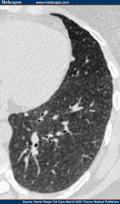 Hypersensitivity Pneumonitis Ct. subacute hypersensitivity