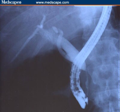 common bile duct cystic duct. Common hepatic duct dilated to