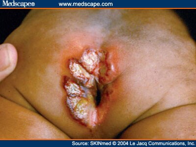 Genital Herpes | Herpes Symptoms | Herpes Simplex ...