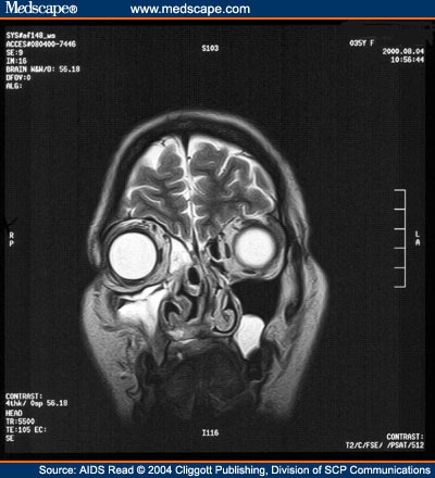 blockage sinus signs and symptoms