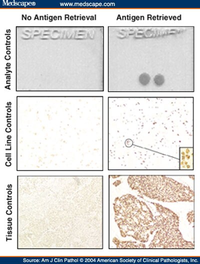 The lack of antigen retrieval