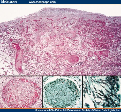 Hemorrhagic Infarct