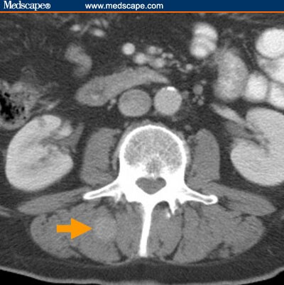 cancer stomach esophagus esophageal cancer japan