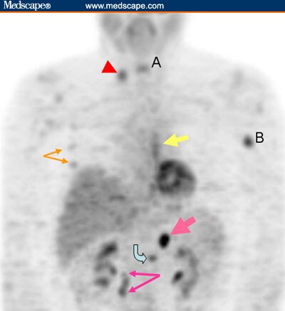 Paraspinal Region