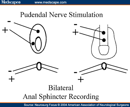 pudendal nerve stimulation
