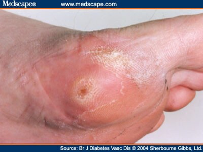 Foot Ulcer Pictures