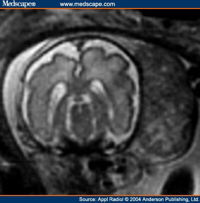 Scalp Tumor