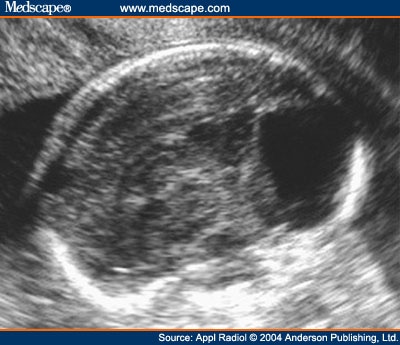 fetus at 6 weeks. Figure 6.