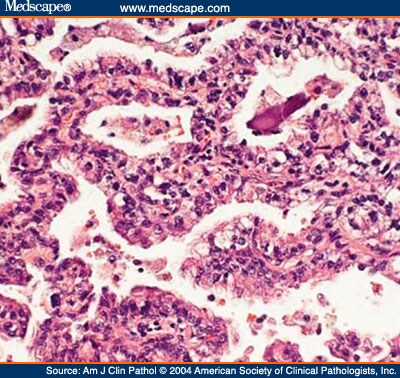 Bronchoalveolar Carcinoma Histology