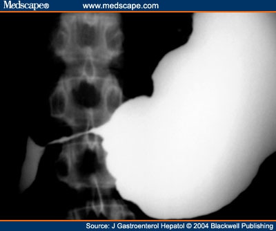 Barium Meal Ulcer