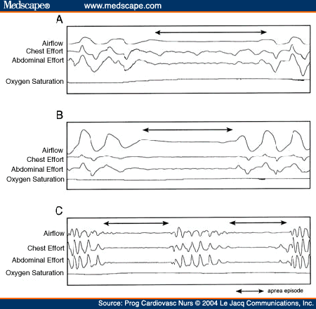 Sleep Apnea, Central; Apnea, Sleep, Central; Central Sleep Apnea ...