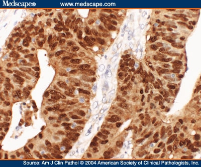 Clinical relevance and frequency of cytoplasmic and nuclear dense