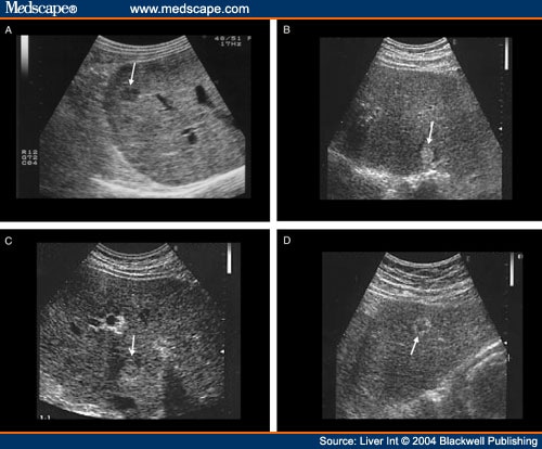  carcinomas detected in patients with liver cirrhosis: hypoechoic (A), 