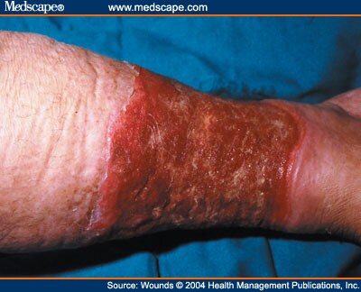 Mesh Graft
