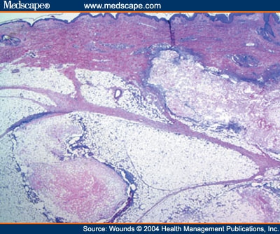  Necrosis on Diagnostic Dilemmas  Pancreatic Panniculitis  Investigations