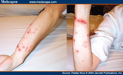 mild poison ivy rash pictures. Lesions of Poison Ivy.