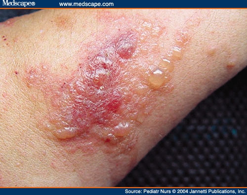 poison ivy pictures on skin. Lesions of Poison Ivy.