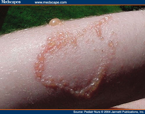 pictures of poison sumac rash. Oak, and Sumac Information