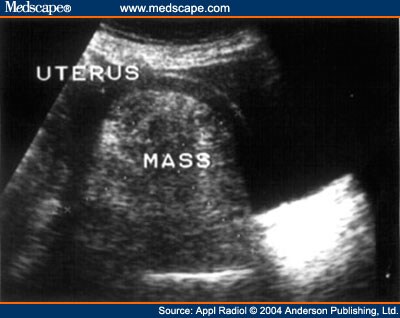 Pelvic Ultrasound Images