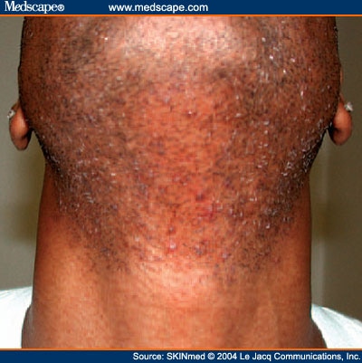 Pseudofolliculitis Barbae Treatment