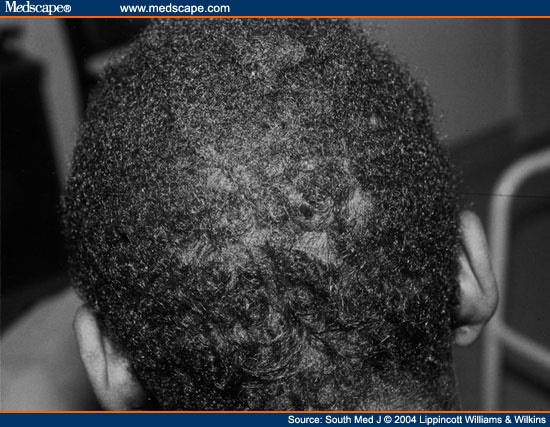 Syphilis Alopecia