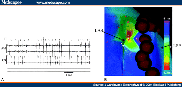 Left Atrial Radiofrequency Ablation on Atrial Fibrillation: Results