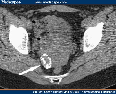 Endometrial Calcification