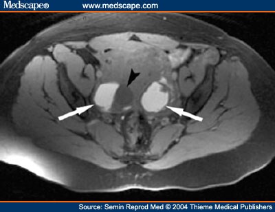 Ct Of Ovaries