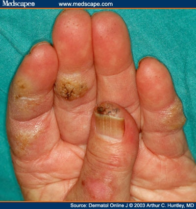 Warts On Fingers. simulating common warts.