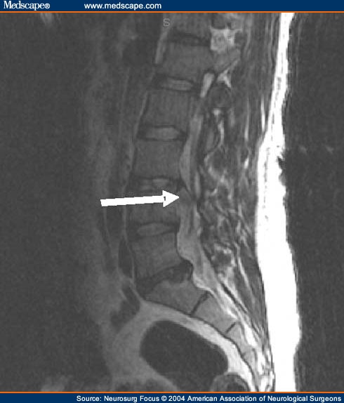 Lumbar Burst Fracture